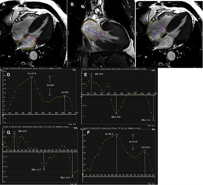 Different phenotype of left atrial function impairment in patients with hypertrophic cardiomyopathy and hypertension: comparison of healthy controls